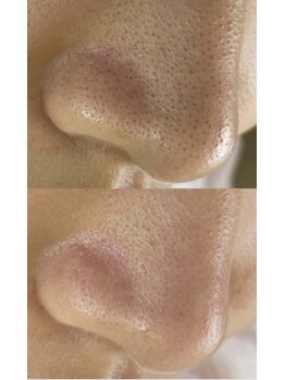 毛穴屋/毛穴のざらざらお任せください