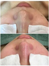 叶(Kanau)/毛穴エクストラクション1回