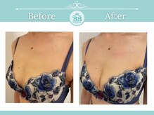 美人バスト 浜松店/◇ バストアップ &nbsp;BeforeAfter◇