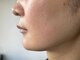 ベリッセ(Belisse)の写真/【スッキリ小顔】浜松希少★脂肪分解レモンボトル×BBL光フォト☆気になるたるみ改善や二重あごに♪