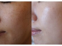トラット エステアンドアイズ(tratto)/30代前半　お客様症例写真