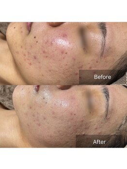 リノリー(rinory)/肌育プログラム