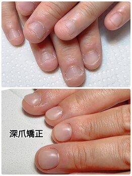 スマイルニコ(smile nico)/看護士さんの深爪