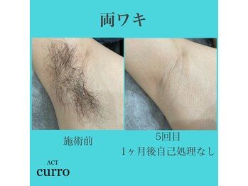 アクト クロ(ACT curro)/【両ワキ】脱毛施術例