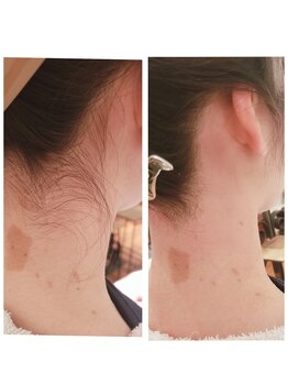 プトゥリ(Putri)/うなじ脱毛で美しい後ろ姿