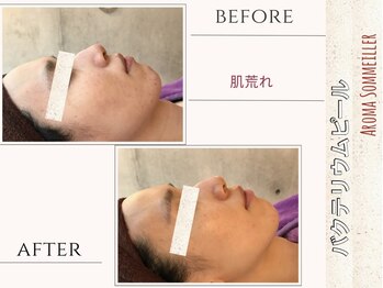 アロマ ソメイエ(Aroma Sommeiller)/バクテリウムピール★なめらか肌