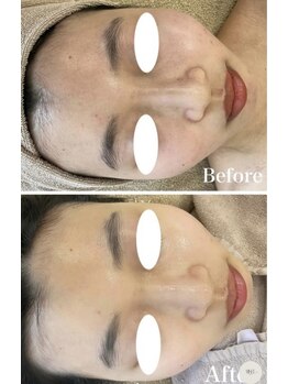 ミセル(MISEL2nd)/お肌のトーンアップにも効果的♪