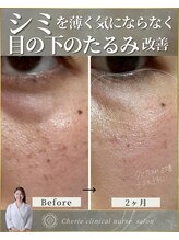 シェリー(Cherie)/インセルダム・目の下たるみシミ