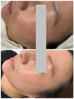 ピーナップ(P-nap)/シミ改善