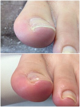 モアクリスタル(More Crystal)/巻き爪補正