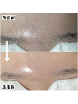 ムク(MUKU)/おでこにも艶