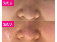 アイビ(愛美)/毛穴洗浄で黒ずみ毛穴改善★