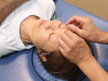 あらた鍼灸整骨院/美容鍼