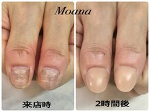 モアナ 池袋(MOANA)/人工爪深爪