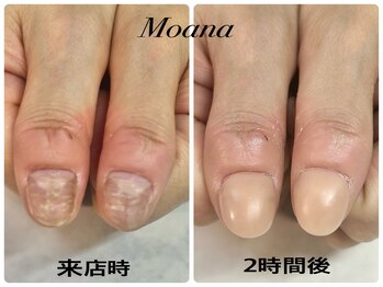 モアナ 池袋(MOANA)/人工爪深爪