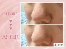 SNSで流行の"韓国肌管理&毛穴洗浄専門店"が待望のNEW OPEN♪