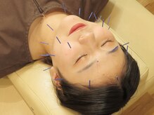 江古田りんく鍼灸整骨院/【美容鍼】