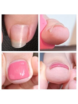 ネイルズ アイコ(nail's aico)/巻き爪ケアジェル