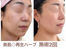 ブルームエイト(Bloom8)の雰囲気（本気美肌◇再生ハーブピーリングも人気！口コミ、ブログを参考に）
