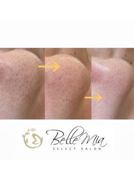 ベルミア(Bellemia)/毛穴汚れにも強いベルミア