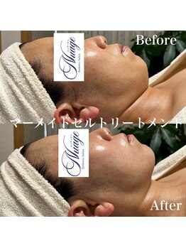 ニュアージュ(Nuage)/フェイスラインもスッキリ