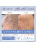 【シミ改善に】トラネキサム酸プラズマ導入 15000円→7500円【先着10名様】