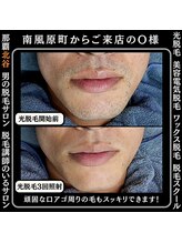 メンズディースタイル 首里店(Men's Dstyle)/首里メンズ脱毛ヒゲBefore after