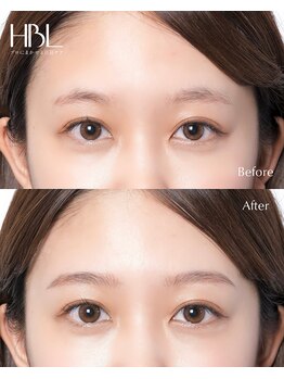 カルス(carus)/HBL before/after