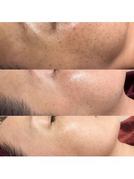 ビューティーワンド ココ(Beauty Wand COCO)/