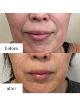 アルル(ARuru)/肌改善症例