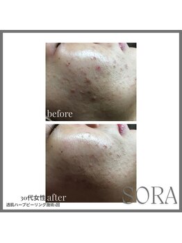 青空 天神大名店(SORA)/透肌ハーブピーリング1回
