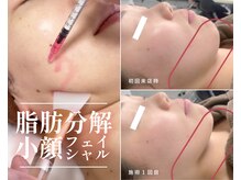 チエミ(Chi e mi)の雰囲気（【プラズマ×脂肪分解美容液レッドショット】小顔リフトアップ）