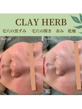 スリジエ ボーテ(cerisierBEAUTE)/しぶとい繰り返しニキビケアに◎