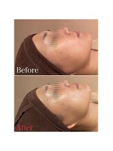 ビューティースタイリング 自由が丘店(beauty styling)/【美白ハーブピーリング】