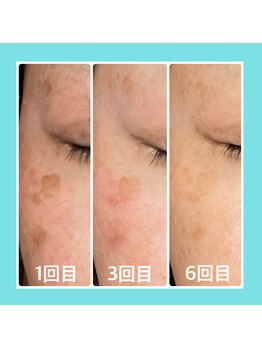 シエン ボーテ 馬車道 関内(Cyen BEAUTE)/6回施術しました