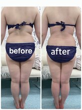 ハロ 南青山(HALO)/全身キャビテーション+ラジオ波