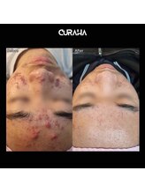 パールブルー(All Perl blue)/韓国最新エステ/ニキビ肌