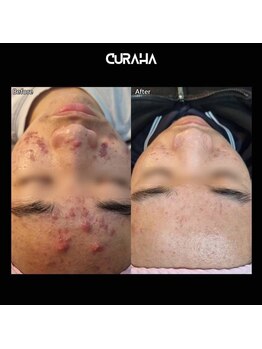 パールブルー(All Perl blue)/韓国最新エステ/ニキビ肌