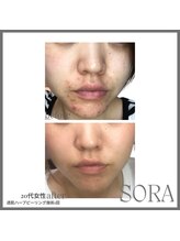 青空 天神大名店(SORA)/透肌ハーブピーリング1回