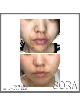 青空 天神大名店(SORA)/透肌ハーブピーリング1回