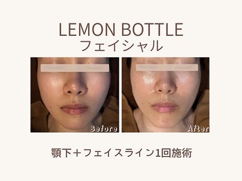 ビーモア(B.MORE)/小顔｜レモンボトルフェイシャル