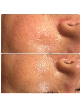 リコ(Relaxation Boutique LICO)/光フェイシャルとの相乗効果◎