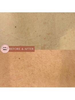 トレテル/全身脱毛2回目背中上