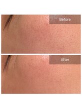 ビビ(VIVI)/ララピール症例