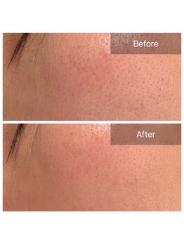 ビビ(VIVI)/ララピール症例