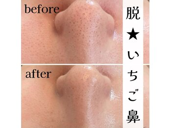 ベレミアム(Bellemium)/鼻の黒ずみ改善