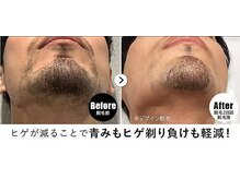 RBL ゆめタウンサンピアン熊本店/メンズ脱毛/ヒゲ脱毛2回目剃毛後