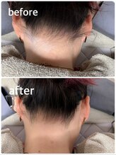 レイワックススタジオ(Lei wax studio)/うなじ脱毛