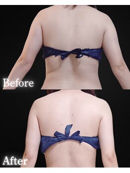 サンティエ(Santie)/背中・腕がスッキリ美しく♪