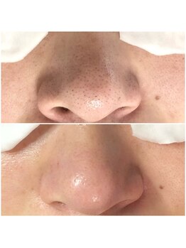 ミラボ(melab)の写真/【毛穴人気No.1】毛穴エクストラクション
￥13,500→￥8,800結果出しエステ★エステ初心者の方にも♪